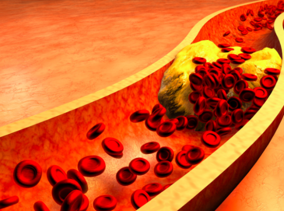 10 Symptoms Of High Cholesterol That You Shouldn’t Ignore