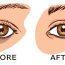 7 Remedies How To Remove Under Eye Dark Circles