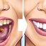 Naturally Whiten Teeth: 10 Ways To Remove Tartar Stains From Your Teeth