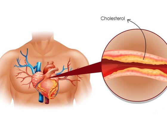 Have 4 Spoons Of This In the Morning And No More Pressure, Cholesterol, Clogged Arteries